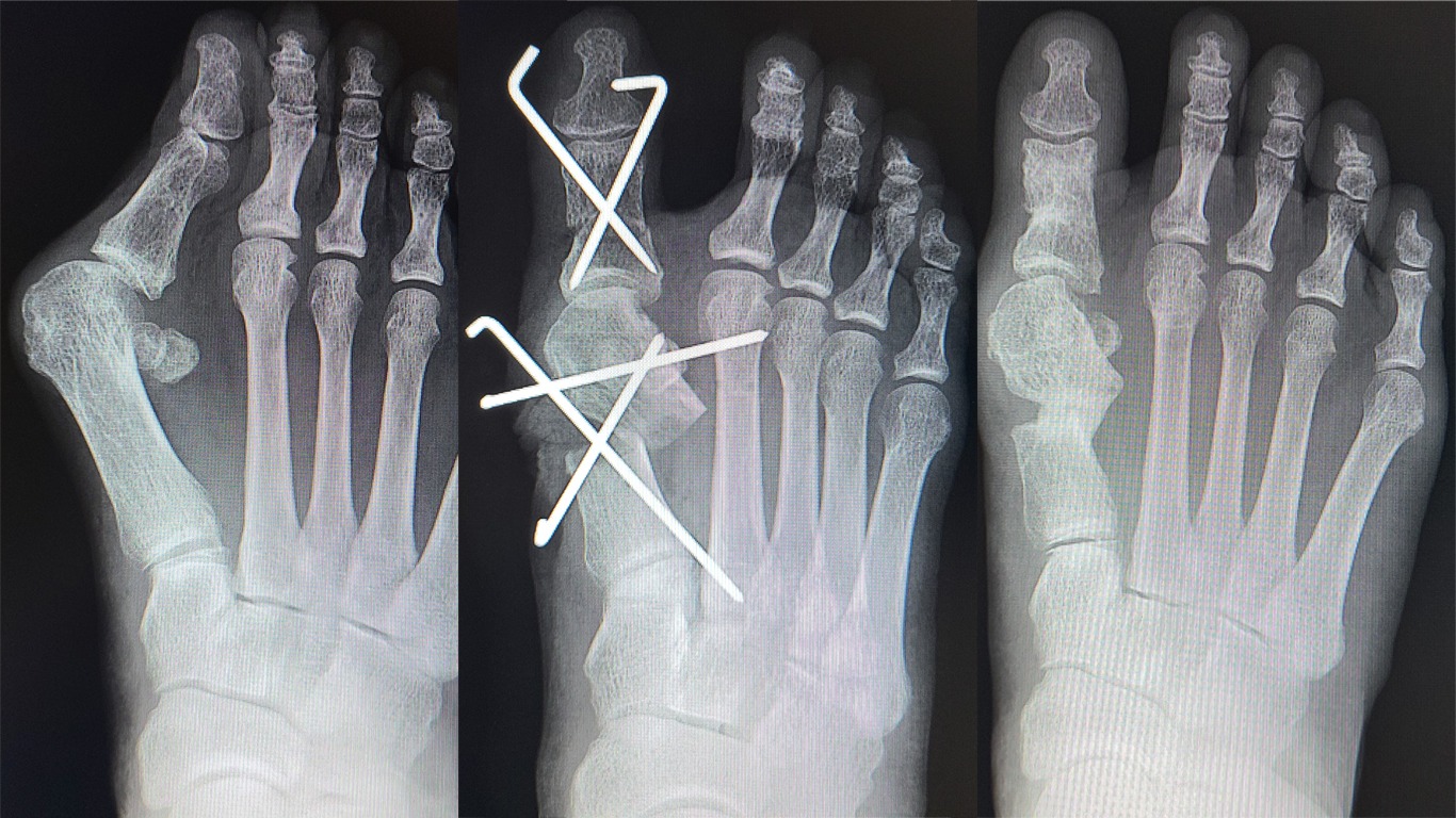 重度の外反母趾に対する手術療法 | あしげブログ