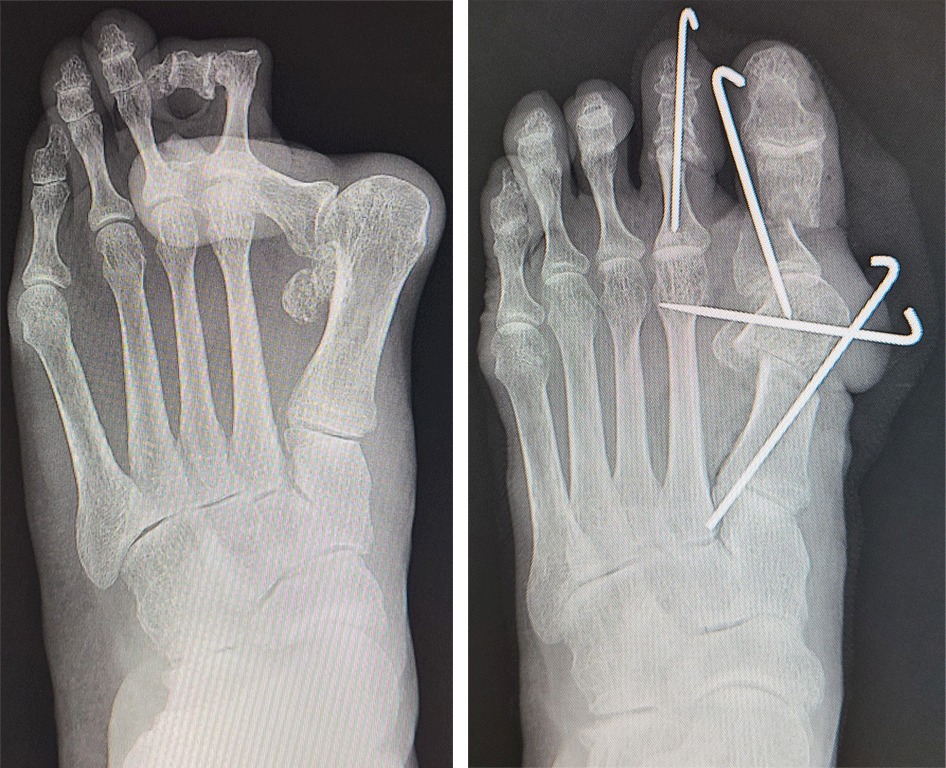 重度外反母趾に対する低侵襲で簡単な手術法 専門医向け あしげブログ