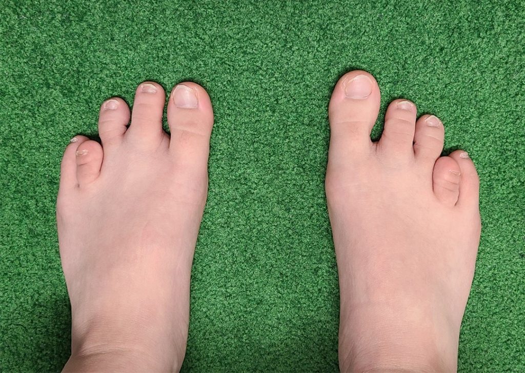 脚の長さの違いはどのように診断されますか?