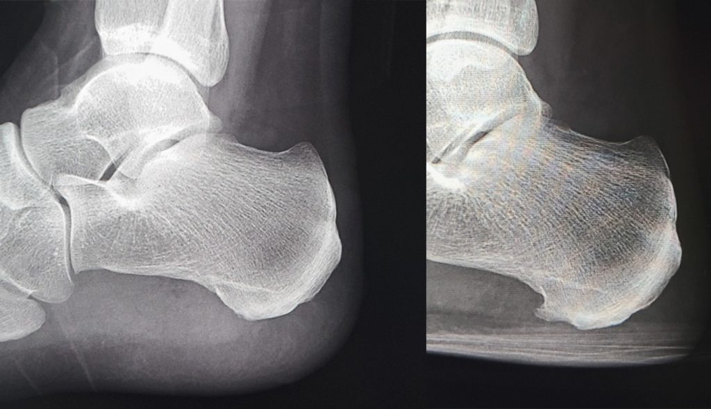 足底筋膜炎の他の治療法にはどのようなものがありますか?